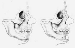 Docteur Nicolas VIDAL. Chirurgie maxillofaciale et esthétique du visage à la Réunion 974. Chirurgie orthognatique maxillaire superieur.