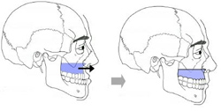 Docteur Nicolas VIDAL. Chirurgie maxillofaciale et esthétique du visage à la Réunion 974. Chirurgie orthognatique maxillaire superieur.