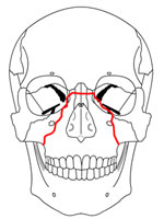 Docteur Nicolas VIDAL. Chirurgie maxillofaciale et esthétique du visage à la Réunion 974. Fracture du maxillaire supérieur Le Fort.