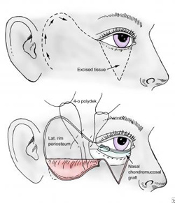 Docteur Nicolas VIDAL. Chirurgie maxillofaciale et esthétique du visage à la Réunion 974. Les lésions du nez.