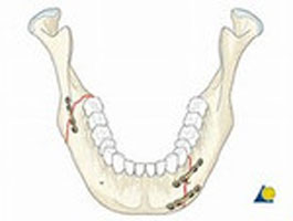 Docteur Nicolas VIDAL. Chirurgie maxillofaciale et esthétique du visage à la Réunion 974. Fractures de la mandibule.